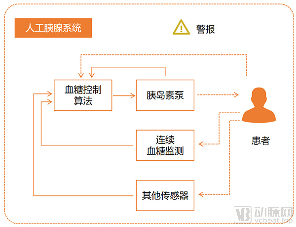 人工胰腺示意图.jpg