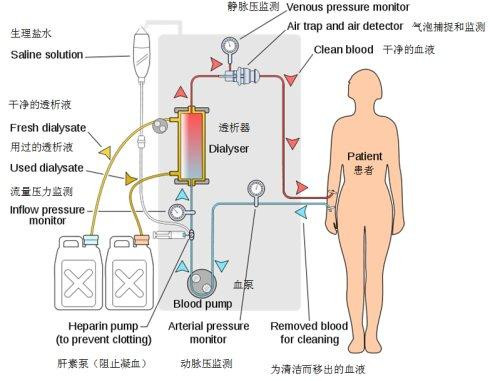 其中包括用于血液净化装置的体外循环血路,一次性使用动静脉穿刺器