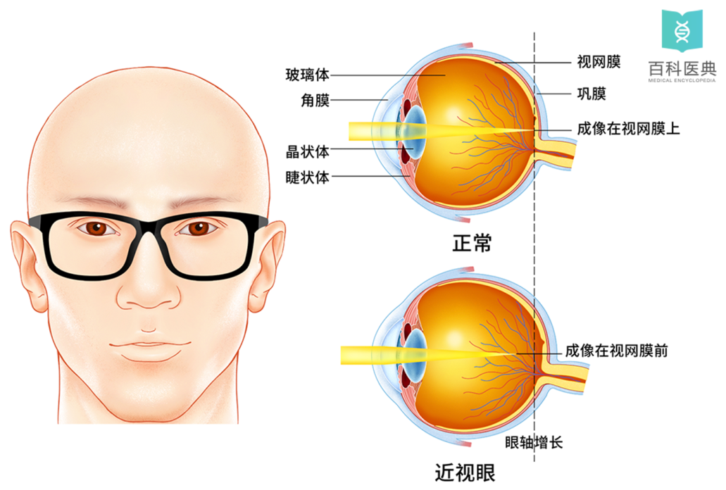 做完近视手术我后悔了