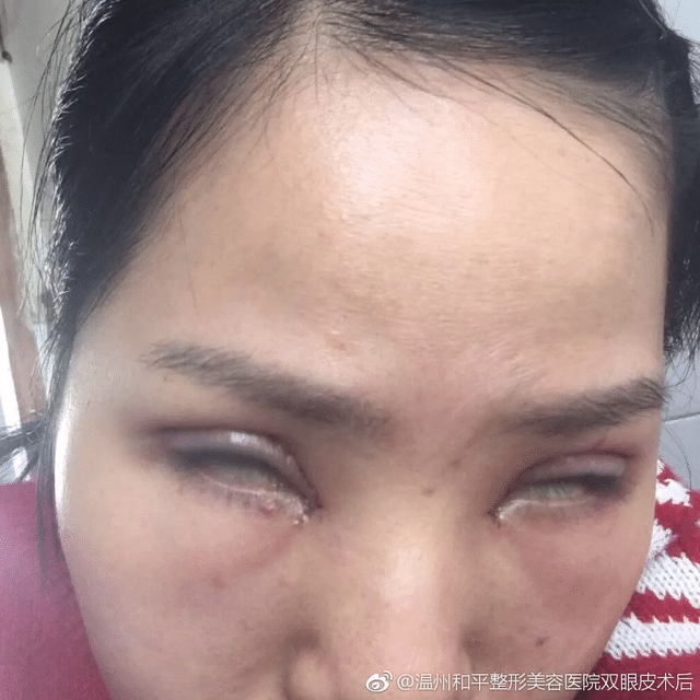 让什么都不会的助手参与操作,还在手术中途离开,下刀超级狠,眼皮内