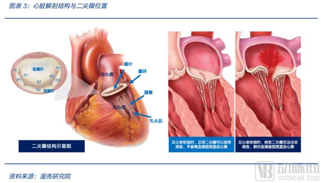 二尖瓣反流治疗图片