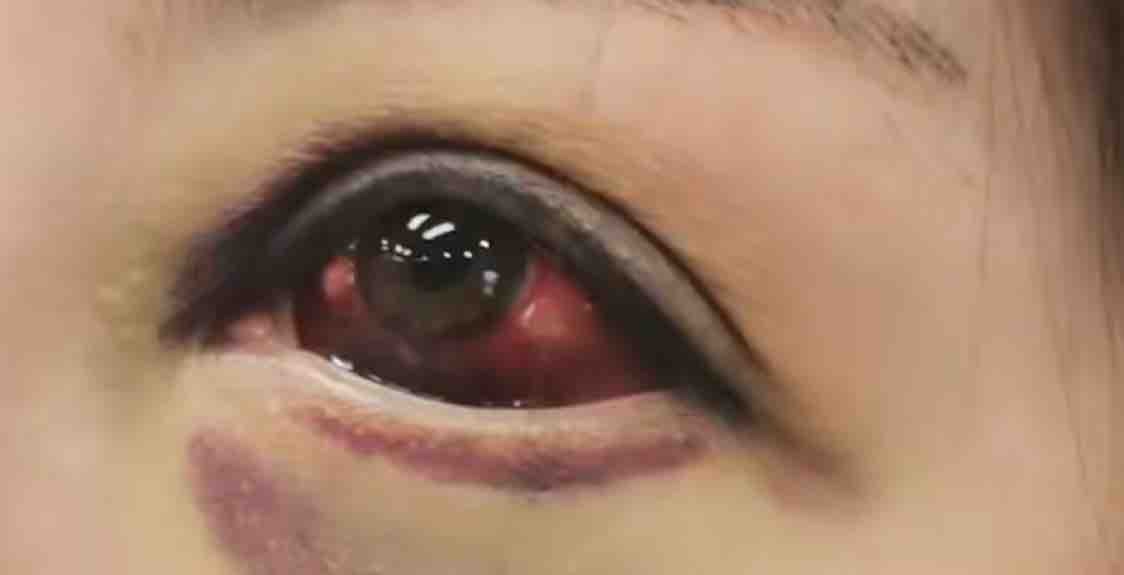 术后眼球充血医疗鉴定存疑西安艺星医疗美容再陷维权纷争