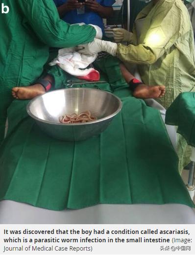 四岁小男孩因长期便秘肚子痛呕吐被送医竟是寄生虫搞的鬼