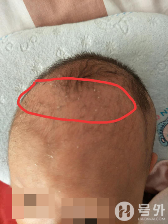 洗发剂变脱发剂出生37天婴儿头发掉光网易考拉被指售假